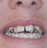 before image of 14 year old girl Close-up of smile showing damaged front teeth with chips and uneven appearance