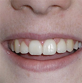 before image of 14 year old girl Close-up of smile showing damaged front teeth with chips and uneven appearance