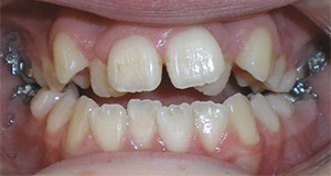 before image of 14 year old girl Close-up of teeth with dental braces showing tooth misalignment and spacing issues