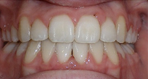 before image of 14 year old girl Close-up of teeth with dental braces showing tooth misalignment and spacing issues