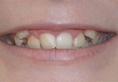 before image of 13 year old girl Close-up of smile showing discolored and misaligned teeth with irregular spacing