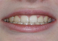 before image of 13 year old girl Close-up of smile showing discolored and misaligned teeth with irregular spacing