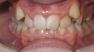 before image of 13 year old girl photo of severe dental malocclusion showing protruding front teeth and significant spacing issues