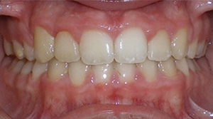 before image of 13 year old girl photo of severe dental malocclusion showing protruding front teeth and significant spacing issues