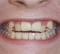 before image of 12 year old girl Close-up of smile showing yellowed, uneven teeth with visible staining and minor crowding