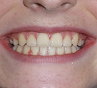 before image of 12 year old girl Close-up of smile showing yellowed, uneven teeth with visible staining and minor crowding