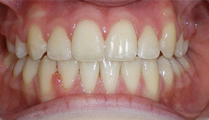 before image of 12 year old girl close up of smile showing uneven and discoloured teeth