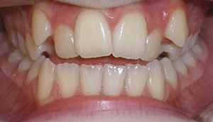 before image of 12 year old girl close up of smile showing uneven and discoloured teeth