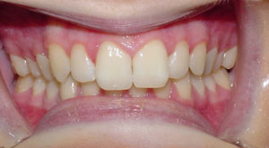 before image of 23 Year old Female Clear Braces on upper teeth only for 6 months