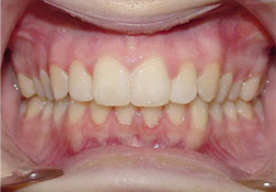 before image of 23 Year old Female Clear Braces on upper teeth only for 6 months