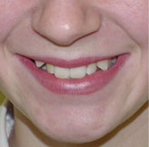 before image of 13 year old girl 4 side teeth removed, fixed braces, 20 months