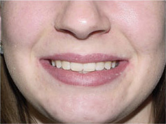 before image of 13 year old girl 4 side teeth removed, fixed braces, 20 months