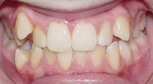 before image of 13 year old girl 4 side teeth removed, fixed braces, 20 months