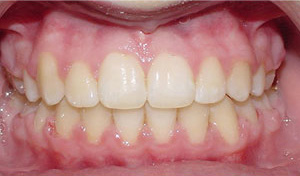 before image of 13 year old girl 4 side teeth removed, fixed braces, 20 months