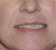 before image of 46 year old lady Clear braces for 19 months