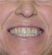 before image of 46 year old lady Clear braces for 19 months