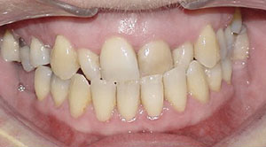 before image of 46 year old lady Clear braces for 19 months