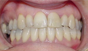 before image of 46 year old lady Clear braces for 19 months