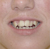 before image of 16 year old girl Initial brace to widen top jaw bone followed by fixed braces to straighten teeth - total treatment time 27 months