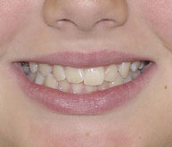 before image of 12 year old girl non extraction treatment with fixed braces, 24 months