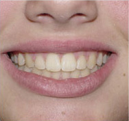 before image of 12 year old girl non extraction treatment with fixed braces, 24 months