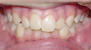 before image of 12 year old girl non extraction treatment with fixed braces, 24 months