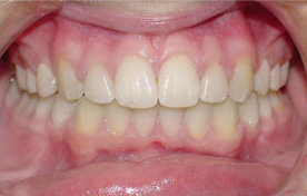 before image of 12 year old girl non extraction treatment with fixed braces, 24 months