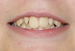 before image of 14 year old boy non extraction treatment, fixed braces - 21 months