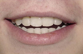 before image of 14 year old boy non extraction treatment, fixed braces - 21 months