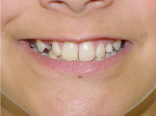 before image of 13 year old girl non extraction treatment, fixed braces, 22 months