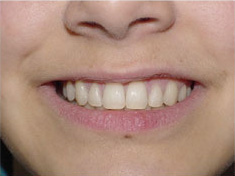 before image of 13 year old girl non extraction treatment, fixed braces, 22 months