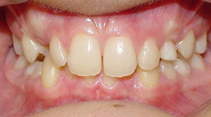 before image of 13 year old girl non extraction treatment, fixed braces, 22 months