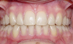 before image of 13 year old girl non extraction treatment, fixed braces, 22 months