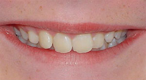 before image of 12 year old girl non extraction treatment, fixed braces, 22 months