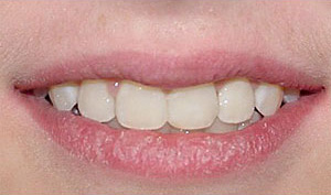 before image of 12 year old girl non extraction treatment, fixed braces, 22 months