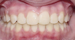 before image of 12 year old girl non extraction treatment, fixed braces, 22 month