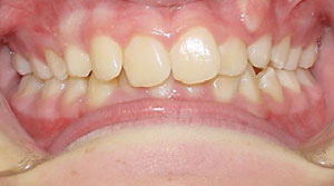 before image of 12 year old girl non extraction treatment, fixed braces, 22 month