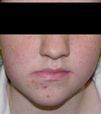 before image of 18 year old girl surgery to correct assymetical lower jaw and braces to straighten teeth - 27 months