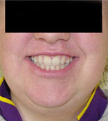 before image of 18 year old girl surgery to correct assymetical lower jaw and braces to straighten teeth - 27 months