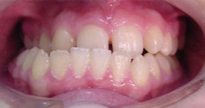 before image of 18 year old girl surgery to correct assymetical lower jaw and braces to straighten teeth - 27 months