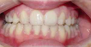 before image of 18 year old girl surgery to correct assymetical lower jaw and braces to straighten teeth - 27 months