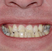 before image of 31 year old man 3 teeth removed , clear braces - 17 months