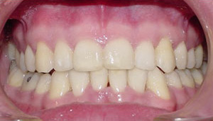 before image of 31 year old man 3 teeth removed , clear braces - 17 months