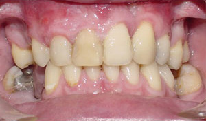 before image of 34 year old man fixed braces, 18 months