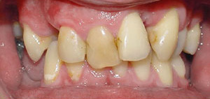 before image of 34 year old man fixed braces, 18 months