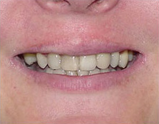 before image of 34 year old man fixed braces, 18 months