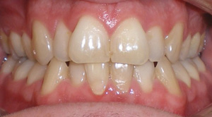 before image of 29 year old man White braces for 4 months to straighten top and bottom front teeth without changing the bite