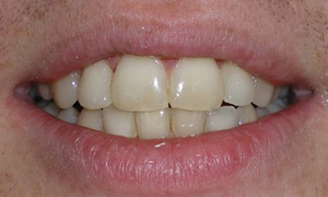 before image of 29 year old man White braces for 4 months to straighten top and bottom front teeth without changing the bite